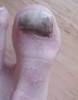 treated to a crusty toenail